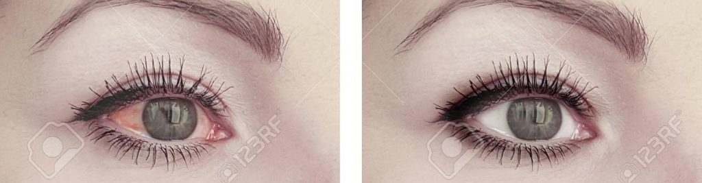 inr-bnr2 - Accuvision Dry Eye