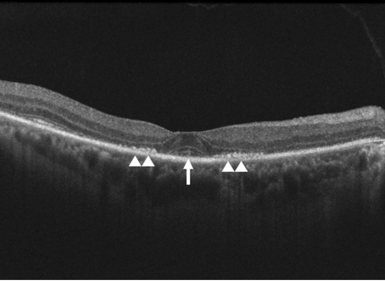 Plaquenil - Accuvision Dry Eye